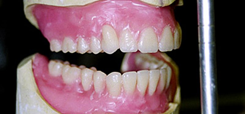 Пошаговая техника постановки зубов в полном съемном протезе по-американски
